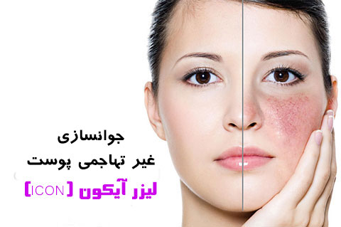 لیزر آیکون (ICON) دکتر رهاب