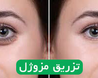 تزریق مزوژل دکتر رهاب