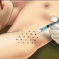 تزریق بوتاکس زیر بغل دکتر ماندانا رهاب