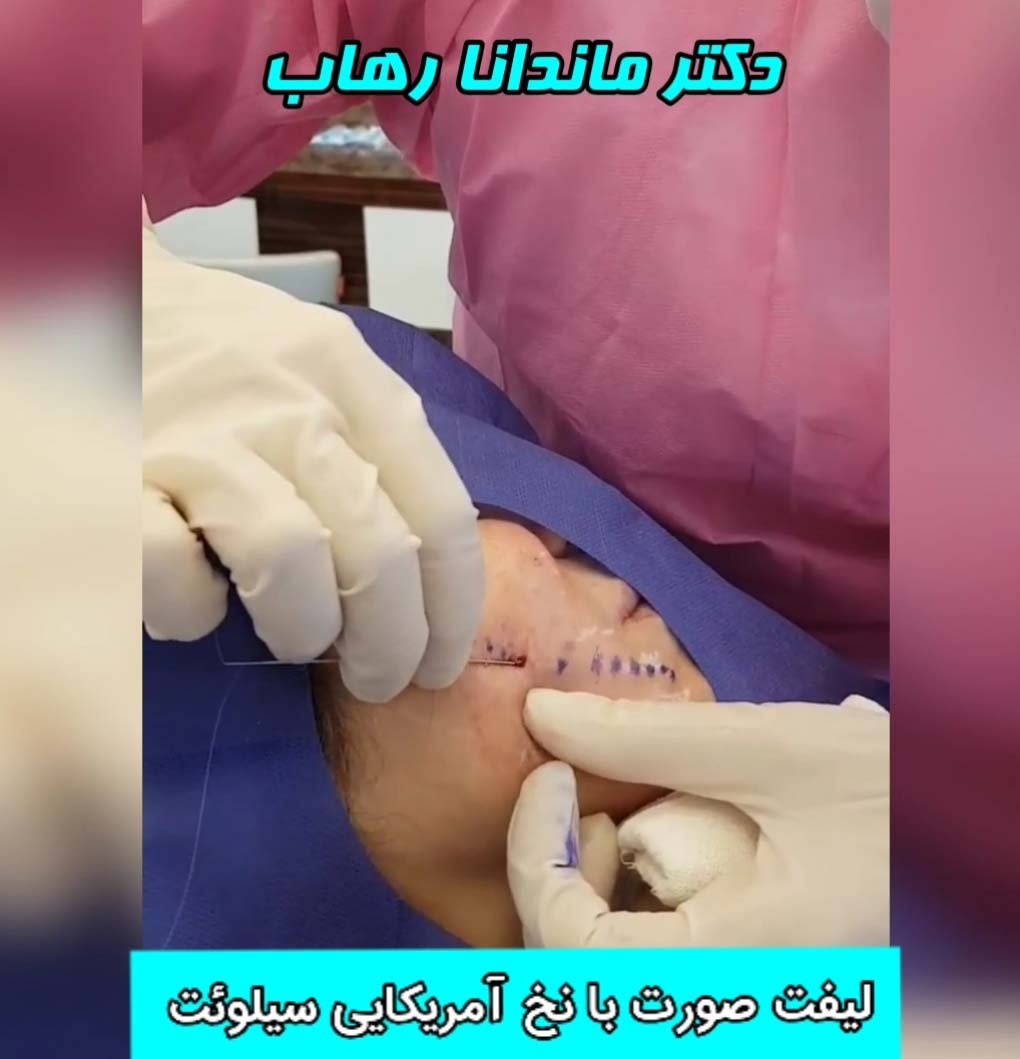 لیفت با نخ سیلوئت تهران