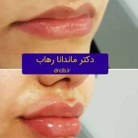 تزریق ژل فیلر بوتاکس هزینه مزایا معایب