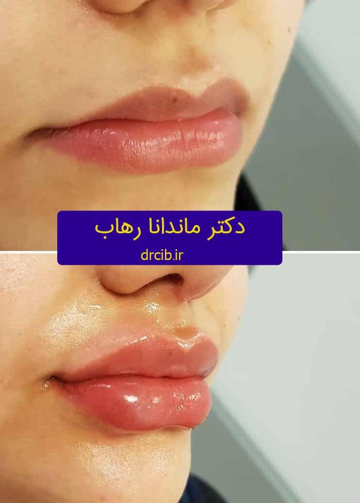 تزریق ژل فیلر بوتاکس هزینه مزایا معایب