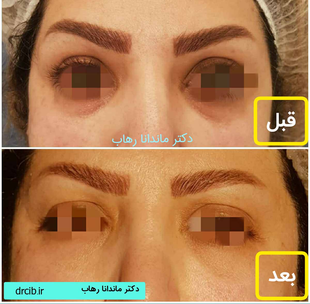 تزریق فیلر زیر چشم کبودی زیر چشم