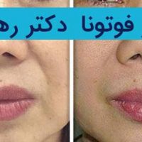 لیزرفوتونا-دکتر-رهاب