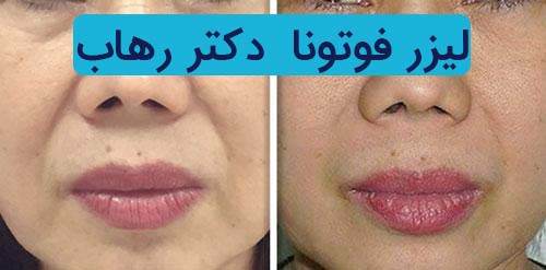 لیزرفوتونا-دکتر-رهاب