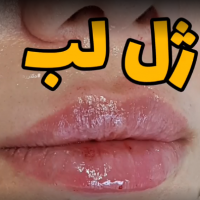 تزریق ژل لب دکتر ماندانا رهاب