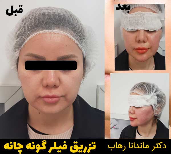 تزریق-فیلر-گونه-و-چانه
