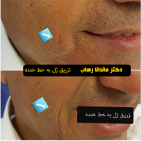 دکتر رهاب فیلر خط خنده
