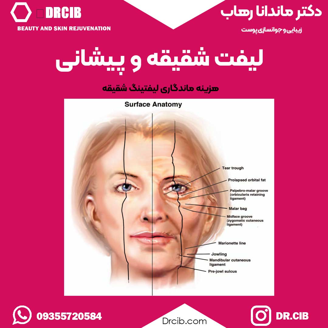لیفت شقیقه یا چشم از زبان بهترین دکتر لیفت شقیقه بعلاوه فیلم واقعی عمل لیفت شقیقه