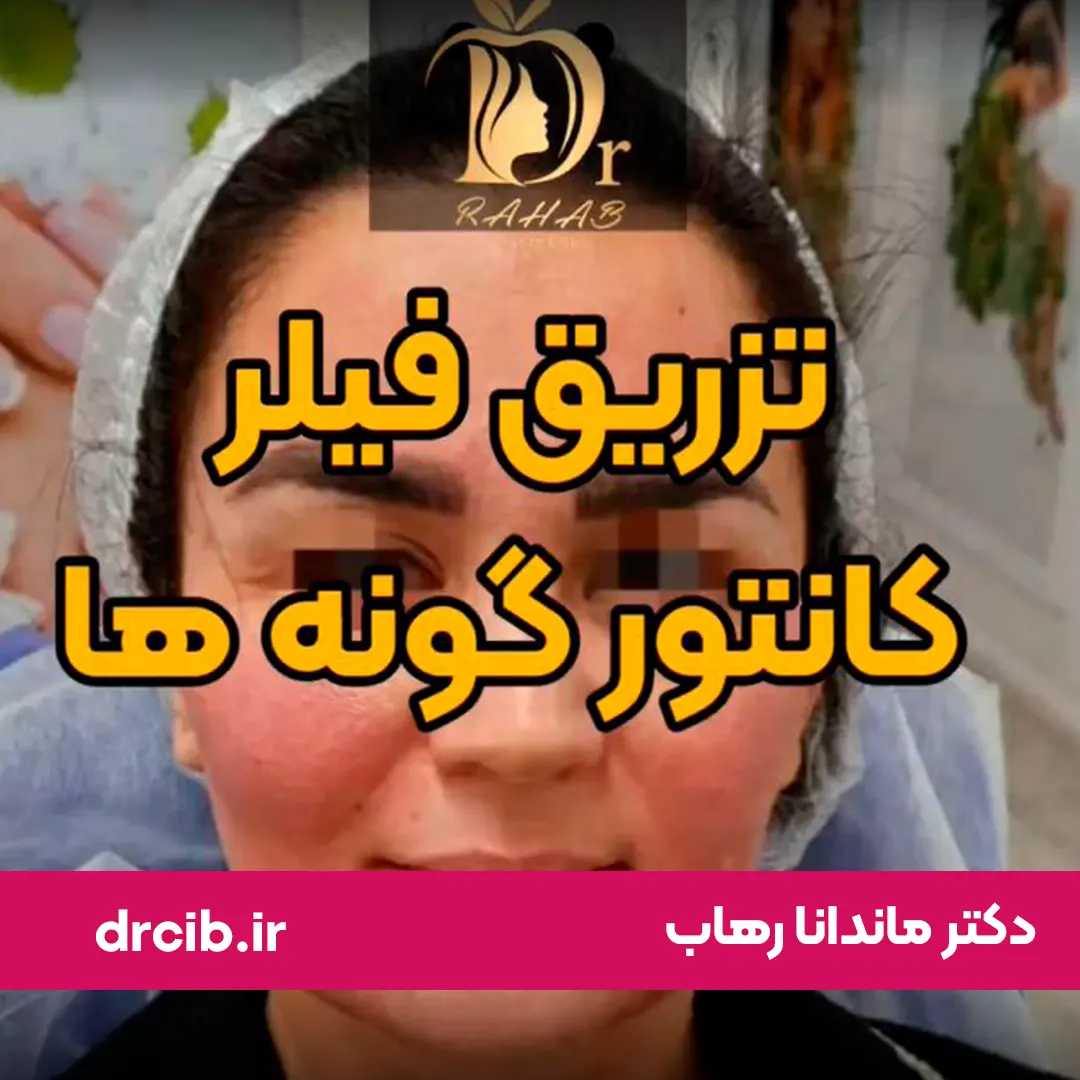 تزریق فیلر یک طرف صورت، لیفت گوشه لب، کانتورینگ گونه ها