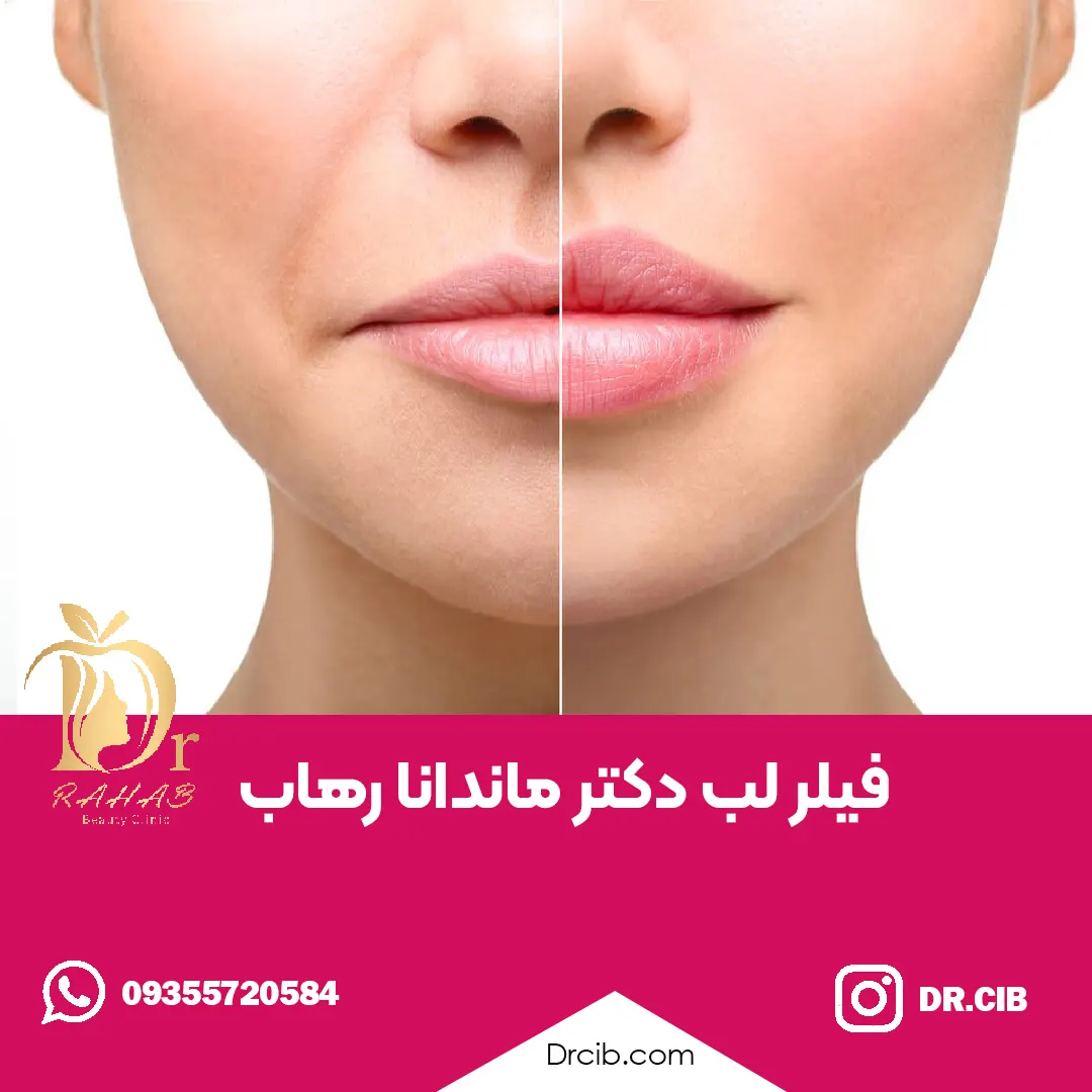 فیلر لب دکتر ماندانا رهاب