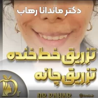 فیلر خط خنده گونه دکتر رهاب
