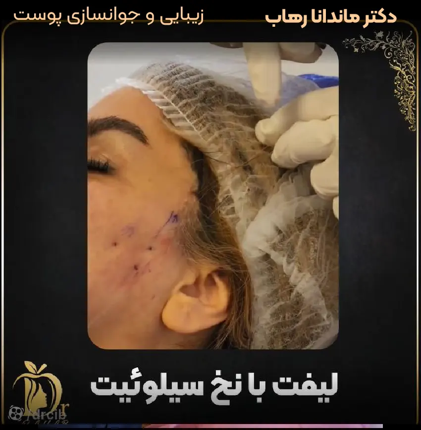 لیفت نخ سیلوئیت دکتر ماندانا رهاب