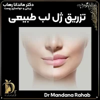 تزریق ژل لب طبیعی