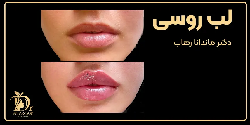 لب روسی قیمت هزینه ماندگاری تهران