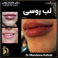 مدل ژل لب روسی دکتر رهاب