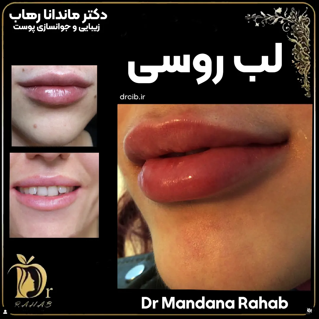 مدل ژل لب روسی دکتر رهاب