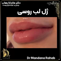 ژل لب روسی دکتر رهاب